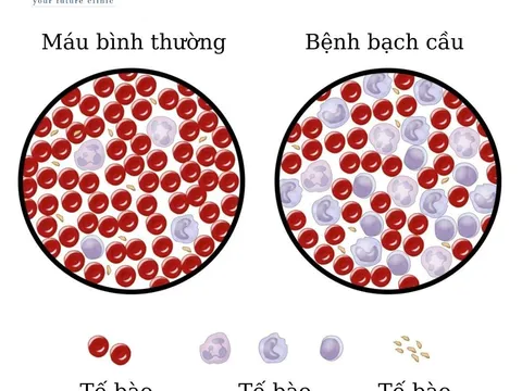 Điều trị bệnh bạch cầu bằng tế bào gốc trung mô