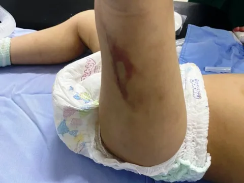 Đà Lạt: Bé 2 tuổi nghi bị bảo mẫu bạo hành đến chấn thương sọ não