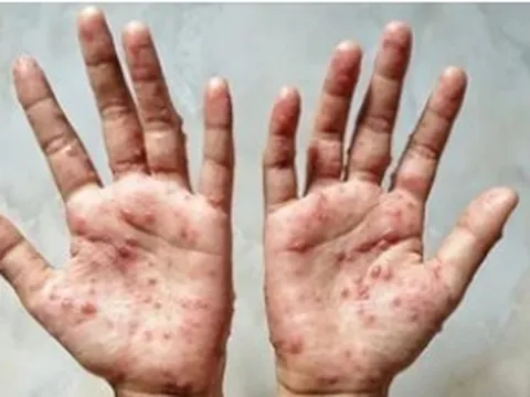 Nóng: Nguy cơ bệnh đậu mùa khỉ xâm nhập Việt Nam, Bộ Y tế họp khẩn