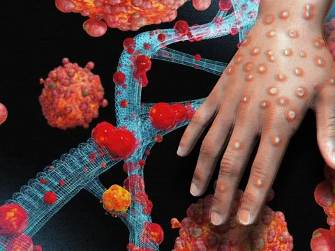 Nguy cơ đậu mùa khỉ lây lan vào Việt Nam: Chuyên gia WHO phân tích, cảnh báo đường lây