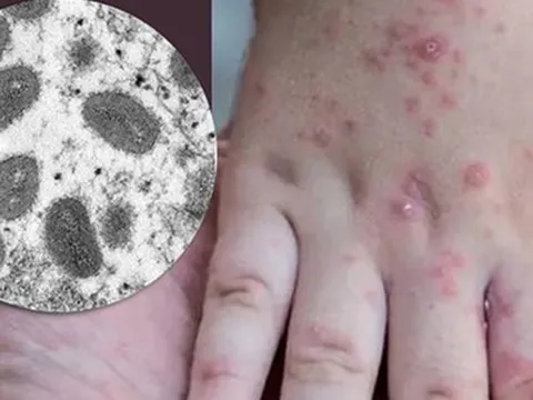 Tốc độ lây nhiễm của đậu mùa khỉ và SARS-CoV-2 khác nhau thế nào?