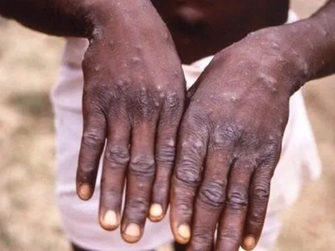 Chuyên gia cảnh báo không chủ quan trước nguy cơ bệnh đậu mùa khỉ