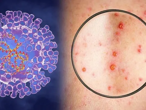 Số mắc đậu mùa khỉ tăng mạnh, Bộ Y tế đưa ra 3 tình huống chống dịch