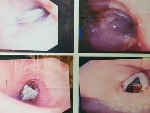 Gắp thành công dị vật là xương ống heo ra khỏi phế quản người bệnh