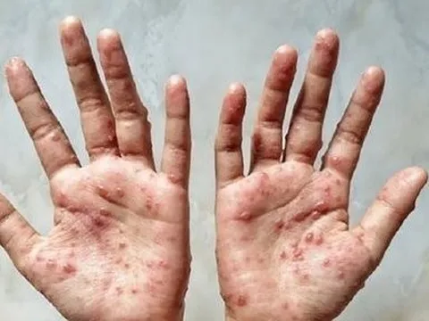 Bệnh đậu mùa khỉ là trường hợp khẩn cấp, Việt Nam có nguy cơ bị xâm nhập rất lớn