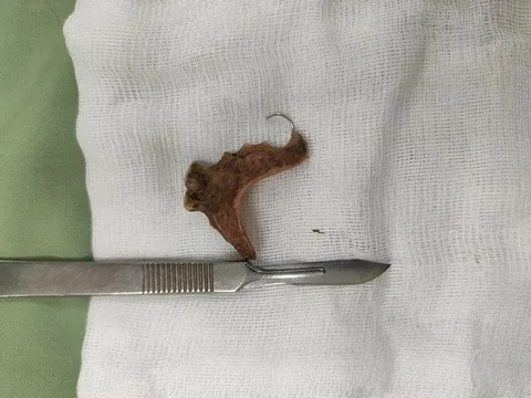 Nuốt hàm răng giả, người phụ nữ đi viện mới biết bị thủng ruột