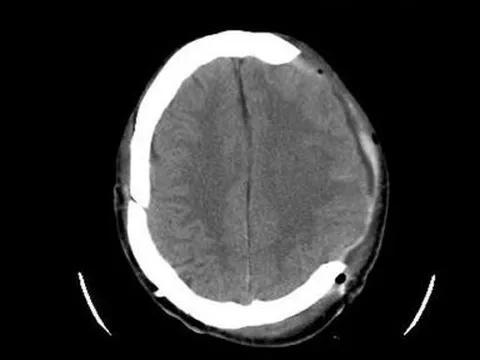 Bị ngã khi đi xe đạp, bé 7 tuổi chấn thương sọ não