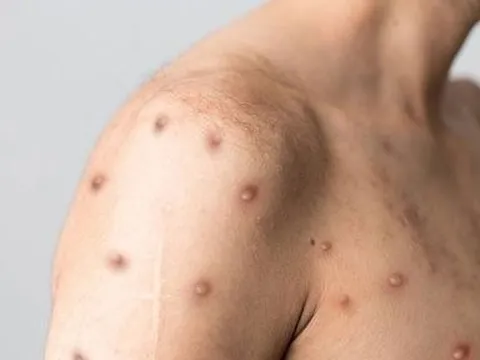 Bộ Y tế đề nghị nghiên cứu sản xuất thuốc phòng, chống đậu mùa khỉ