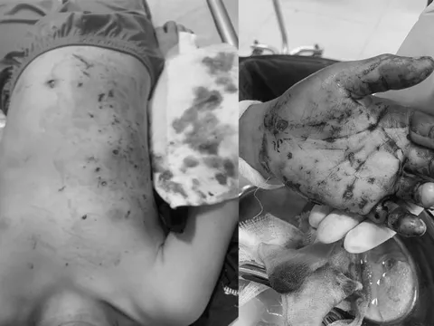 Pin đồ chơi bất ngờ phát nổ, mảnh vỡ văng đầy người bé trai 10 tuổi