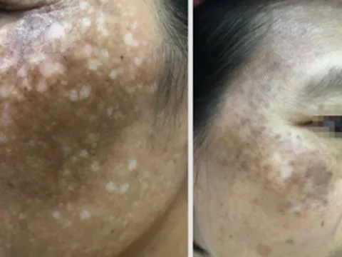 Da mặt loang lổ như pháo hoa vì đắp "thần dược" trị nám, trắng da