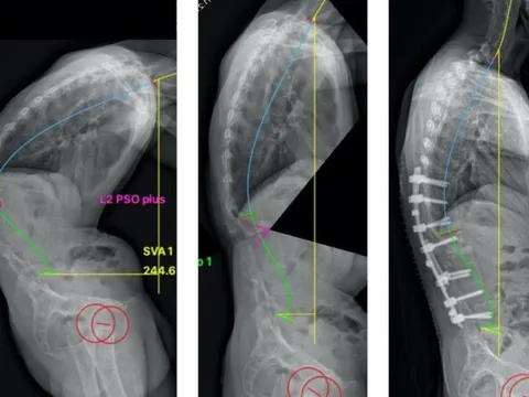 Bệnh loãng xương không điều trị kịp thời sẽ gây hậu quả xấu