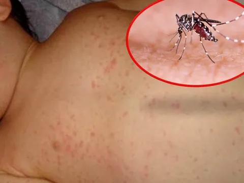 Bé trai 12 tuổi tử vong do mắc sốt xuất huyết tại Đắk Lắk