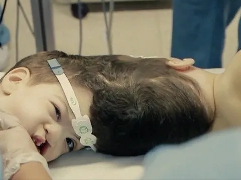 Sức khỏe cặp song sinh dính liền đầu sau phẫu thuật tại Brazil cải thiện từng ngày