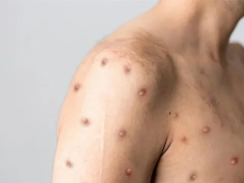 Thêm 2 nước có bệnh nhân đậu mùa khỉ tử vong