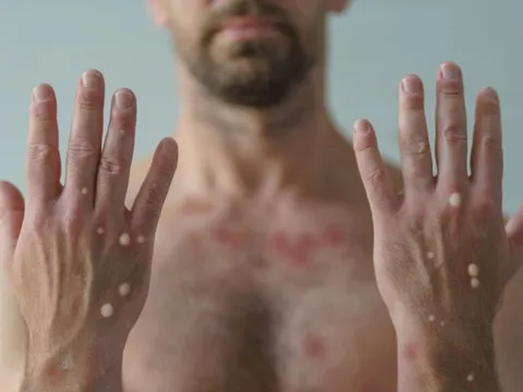 Đậu mùa khỉ: Mỹ báo cáo tử vong nhưng châu Âu đón "tin mừng"