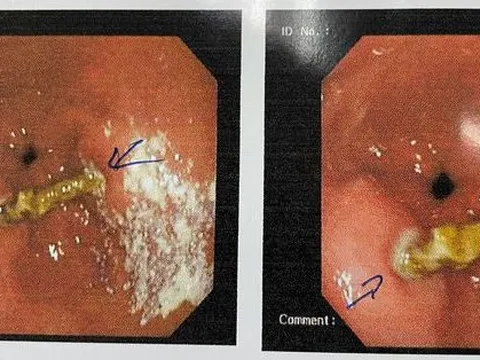 Ớn hình ảnh người đàn ông bị thủng bao tử vì xác trà