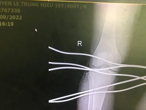 Nam thanh niên 19 tuổi bị 5 thanh sắt đâm xuyên chân