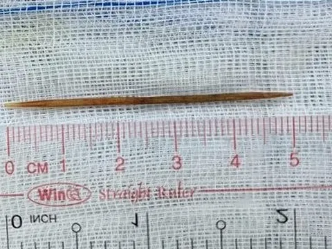 Đến khi thủng ruột, bé trai 8 tuổi mới biết mình nuốt phải dị vật