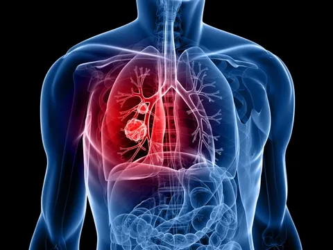 Cảnh báo thứ làm đột biến gien, gây ung thư phổi dù không hút thuốc