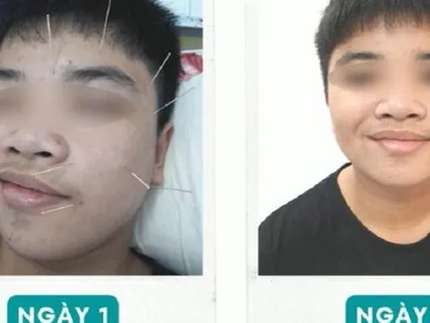 Ngủ dậy, nam sinh tá hỏa vì trúng khẩu nhãn oa tà