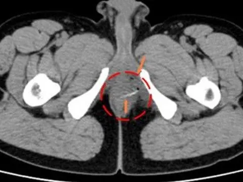 Ớn hình ảnh xương cá chắn ngang hậu môn