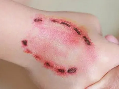 Cảnh báo nhiều ca tử vong vì bệnh dại