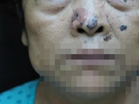 Bệnh viện Da liễu phát cảnh báo về ung thư da ở người trên 60 tuổi