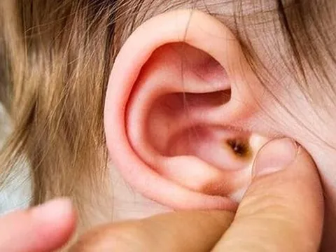 Biến chứng đáng sợ của viêm tai giữa và cách phòng tránh từ chuyên gia