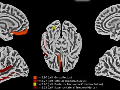 Đã tìm ra cách COVID-19 tấn công não bộ: Lối ra cho người “mắc kẹt"?
