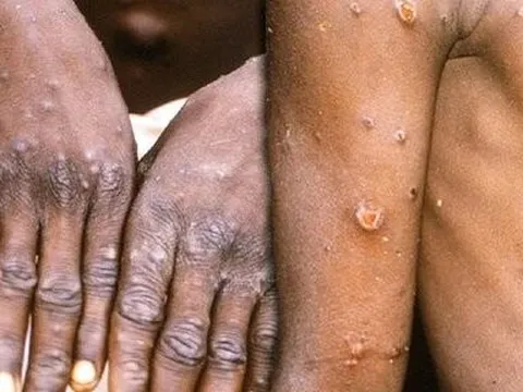 Bộ Y tế thông tin về bệnh nhân đầu tiên mắc Đậu mùa khỉ tại Việt Nam