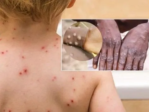 Những ai có nguy cơ cao mắc bệnh đậu mùa khỉ?