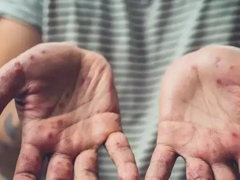 Sức khoẻ của của bệnh nhân mắc bệnh đậu mùa khỉ đầu tiên tại Việt Nam ra sao?