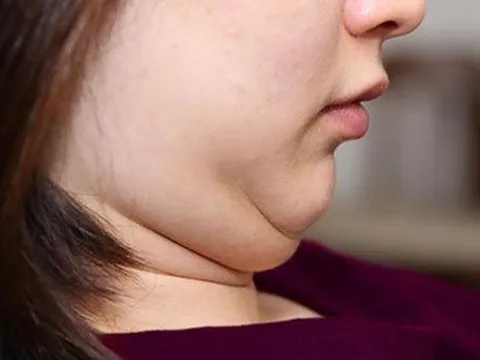 Đoán bệnh qua vị trí mỡ thừa ở từng vùng trên cơ thể của bạn