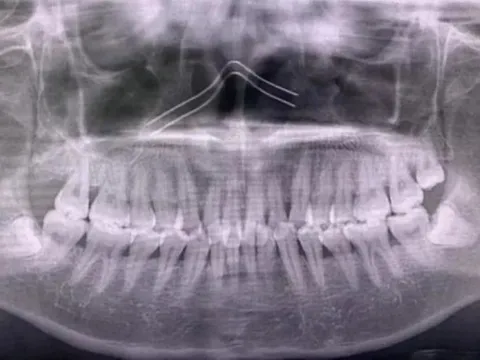 Cô gái tử vong sau khi nhổ 4 chiếc răng khôn cùng lúc