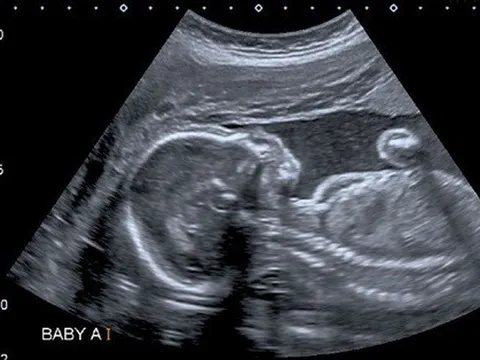 Lần đầu tiên tìm thấy các hạt ‘bồ hóng’ trong cơ thể thai nhi