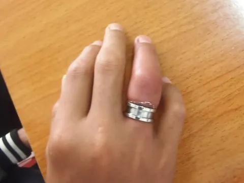 Suýt hoại tử ngón tay sau khi mua nhẫn kim loại trên mạng về đeo
