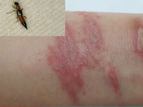 Sai lầm trong điều trị tổn thương do kiến ba khoang