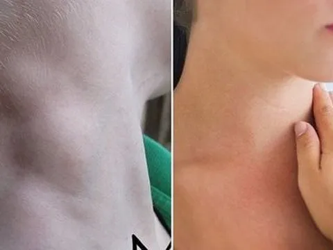 Những loại đồ ăn “cổ vũ” ung thư tuyến giáp phát triển, cần tránh xa