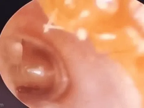 Khoảnh khắc bác sĩ loại bỏ kiến ​​lửa từ bên trong tai bé gái