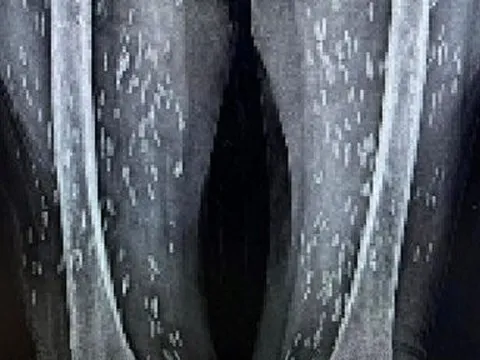 Nghiện món vạn người mê, cụ bà 74 tuổi bị kén sán dày đặc cơ thể