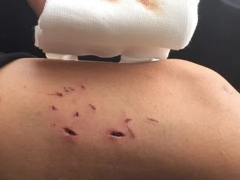 Tham gia làm thịt chó, người đàn ông tử vong vì bệnh dại