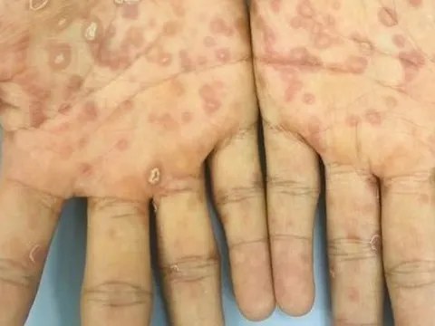 Bác sĩ Da liễu cảnh báo nóng về giang mai