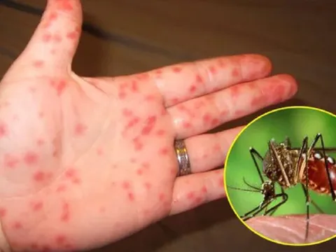 Chuyên gia chỉ ra dấu hiệu cảnh báo nguy hiểm của sốt xuất huyết