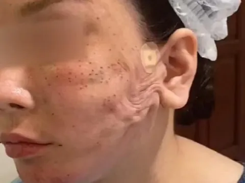 Gương mặt người phụ nữ bỗng trở nên khác lạ sau khi đến spa làm đẹp