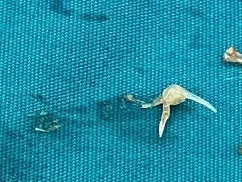Phẫu thuật lấy xương cá dài 1cm gây thủng hồi tràng bệnh nhân