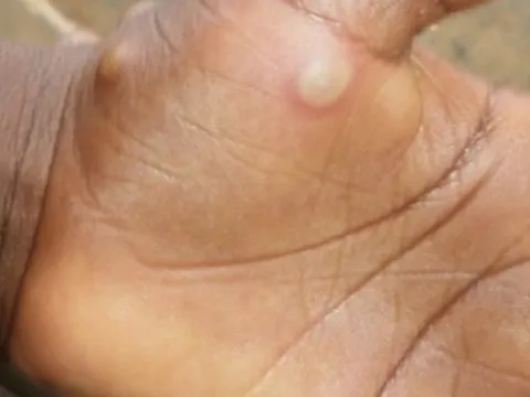 Một trường hợp trở về Đắk Lắk từ Nam Phi nghi mắc đậu mùa khỉ