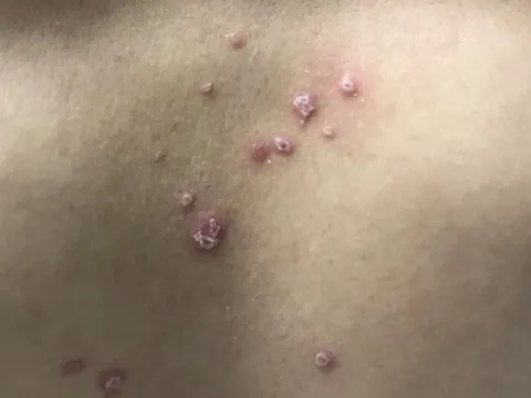 Bé trai hơn 1 tuổi bất ngờ được phát hiện mắc “bệnh người lớn”