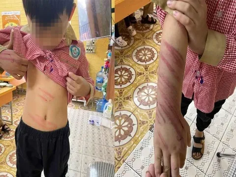 Xác minh vụ bé trai 8 tuổi bị người tình của mẹ bạo hành