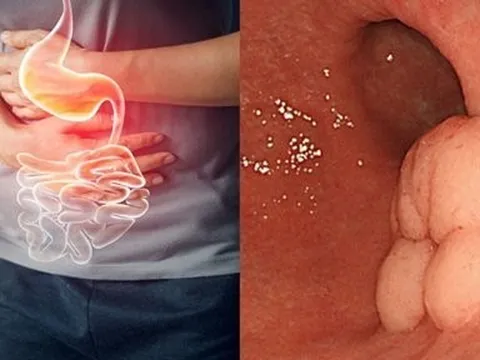 Nhờ dấu hiệu đơn giản người phụ nữ phát hiện mình bị ung thư