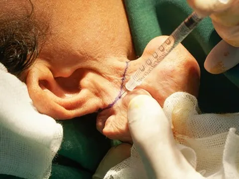 Nữ bệnh nhân bị dị dạng 'tai voi' vì sai lầm nhiều người hay mắc phải